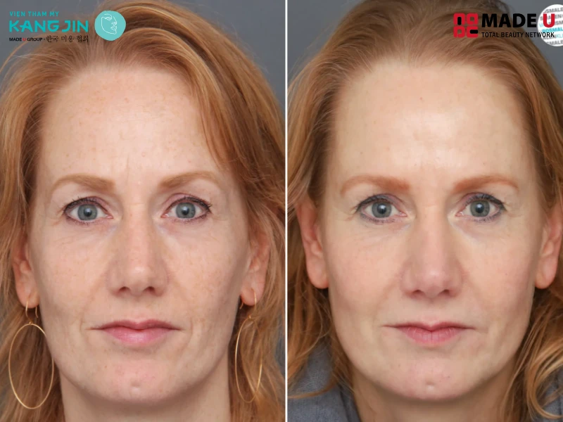 Hóp thái dương là tình trạng thái dương bị lõm vào trong so với các vùng da xung quanh như trán và gò má