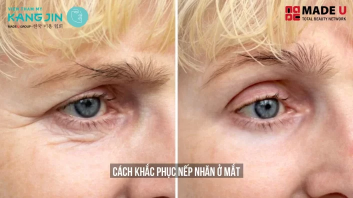 nếp nhắn ở mắt