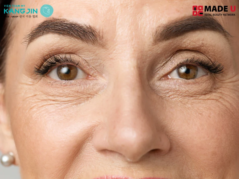 Nếp nhăn ở mắt là dấu hiệu đầu tiên về vấn đề lão hoá của mỗi người