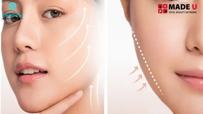 Căng Da Mặt Bằng Chỉ Giá Bao Nhiêu Tiền