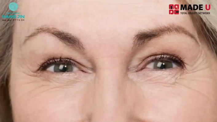 Cách Xóa Nhăn Mắt Tối Ưu