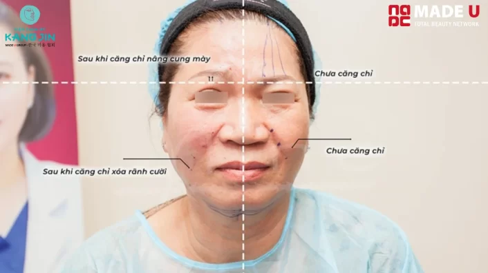 Những biểu hiện sau khi căng chỉ