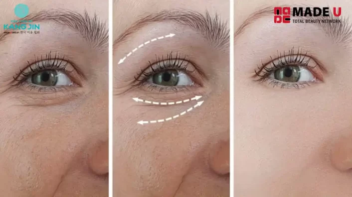 Những biểu hiện sau khi căng chỉ: