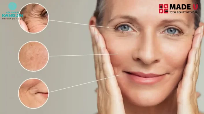 Xóa Nhăn Không Phẫu Thuật