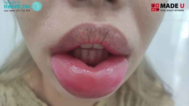 1 số vấn đề sau khi tiêm filler như là sưng đỏ, tấy vùng tiêm filler