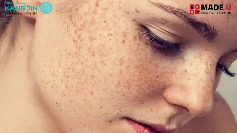 Chăm sóc vết thâm sau khi đốt tàn nhang cực kì quan trọng giúp da nhanh lành