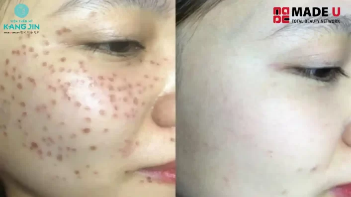 Cách chăm sóc vết thâm sau khi đốt tàn nhang