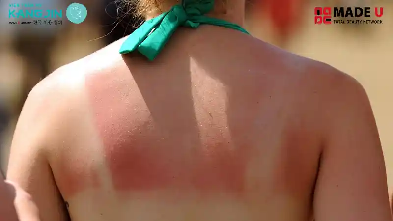 Tia UV chính là nguyên nhân gây ra cháy da, phá hủy collagen gây lão hóa nhanh chóng