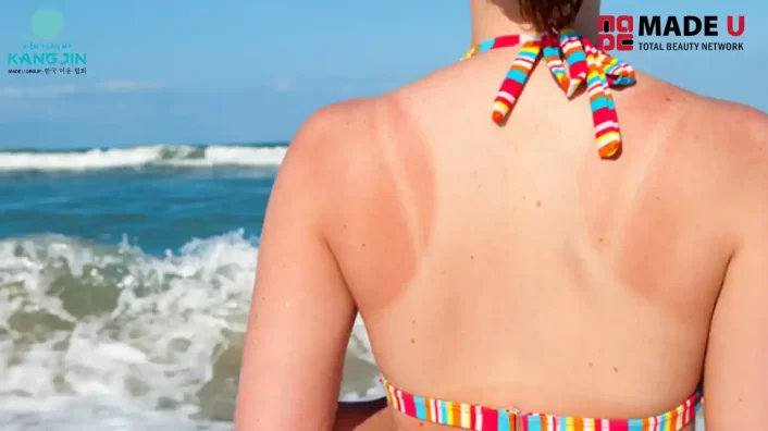 Cách chữa da bị cháy nắng lâu ngày