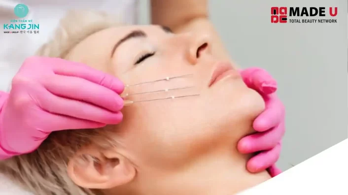 Căng Chỉ Rãnh Cười Giá Bao Nhiêu