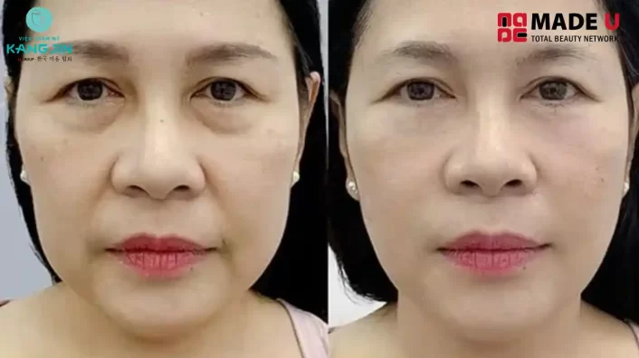 Căng chỉ rãnh cười