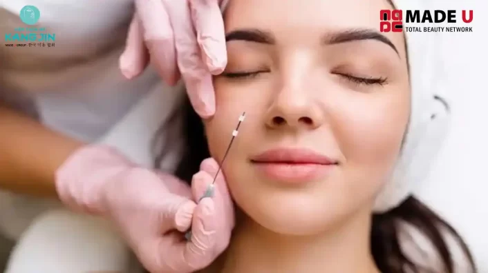 Cấy Chỉ Collagen Làm Đầy Má Hóp