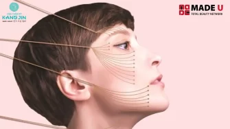 Cấy chỉ căng da mặt – Giải pháp trẻ hóa không phẫu thuật tại Viện thẩm mỹ Kangjin