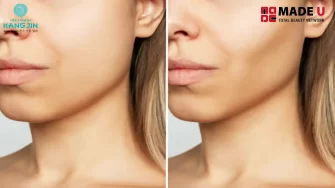 Cấy mỡ má hóp – Giải pháp khắc phục gương mặt hốc hác, lấy lại nét tươi trẻ