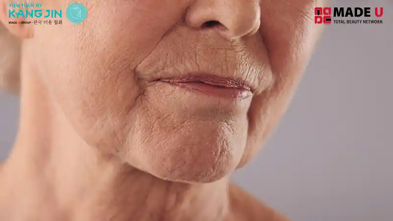 Da chảy xệ vùng má, viền hàm; nọng cằm nhẹ–vừa.