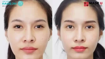Phẫu Thuật Hạ Gò Má Giá Bao Nhiêu? Giải Pháp Trẻ Trung Tại Kangjin