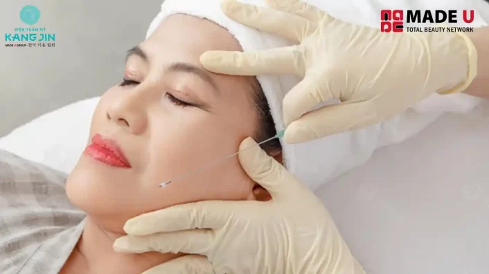 Cấy chỉ collagen có tốt không