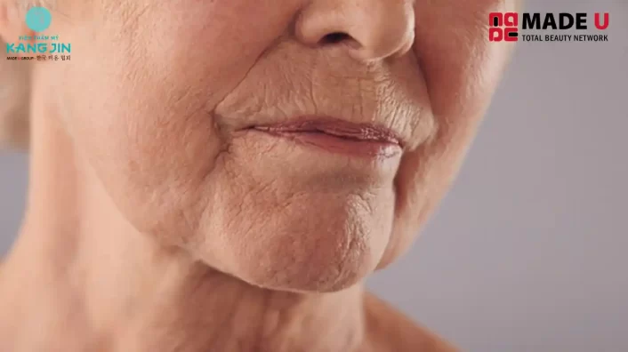 da mặt nhăn sau giảm cân