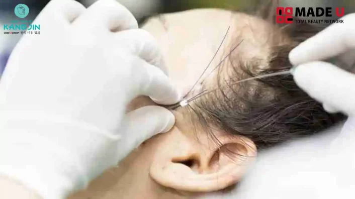 phẫu thuật căng da