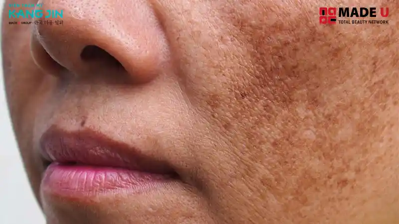 Nám da là tình trạng tăng sắc tố da, gây ra các vùng da tối màu.