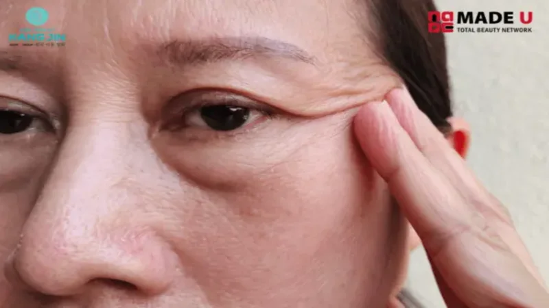 Theo thời gian, các mô liên kết dưới da bị lỏng lẻo khiến vùng da bị chảy xệ