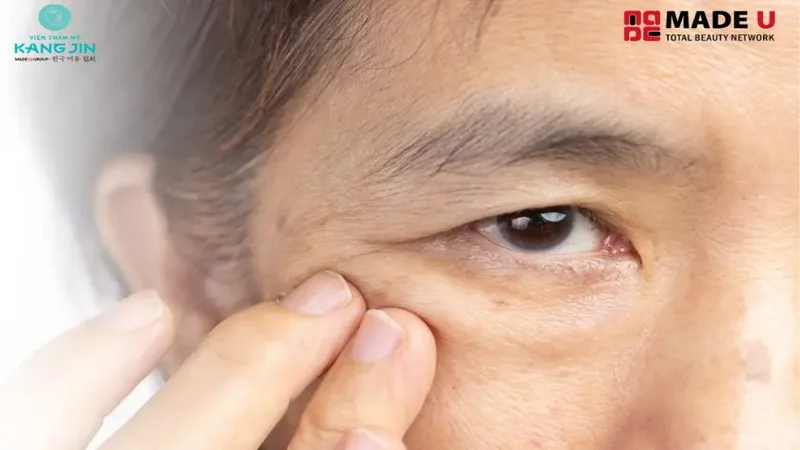Vùng da trên mí chảy xệ che khuất tầm nhìn