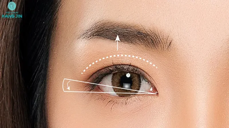 Treo cung mày là một trong những giải pháp nâng mí sụp được ưa chuộng