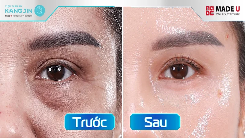 Khách hàng trẻ hóa vùng mặt tại Kangjin