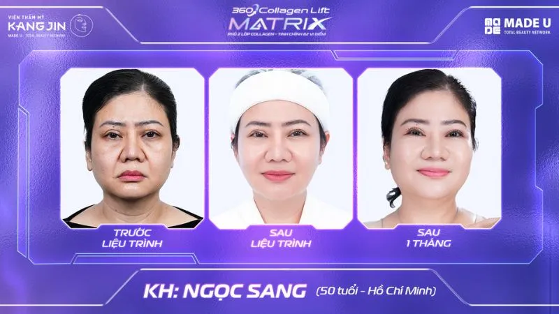 Kết quả thực tế khách hàng sau khi thực hiện liệu trình trẻ hóa 360 Collagen Lift Matrix tại VTM KangJin 