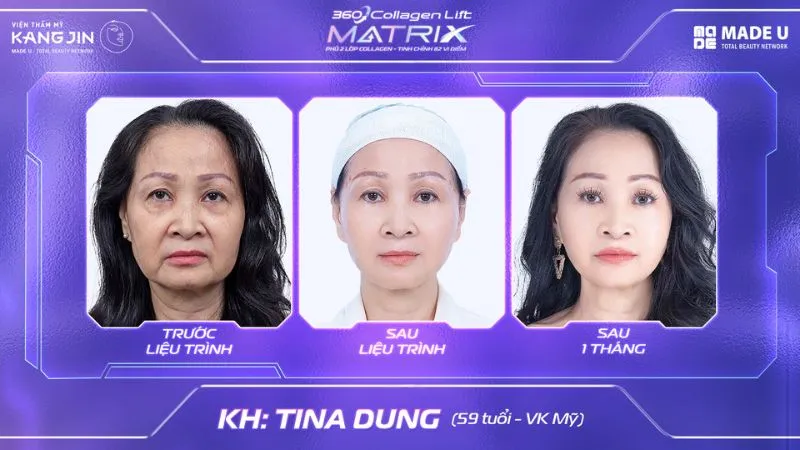 Hình ảnh khách hàng trẻ hóa da toàn diện bằng 360 Collagen Lift Matrix tại VTM KangJin 