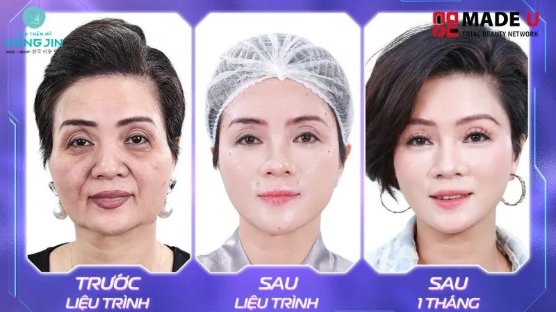 360 collagen lift matrix