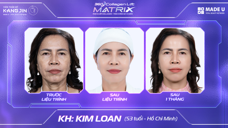 Nâng cơ mặt 360 Collagen Lift Matrix tại Viện Thẩm Mỹ Kangjin – công nghệ độc quyền giúp da săn chắc, nâng cơ, trẻ hóa toàn diện mà không cần phẫu thuật
