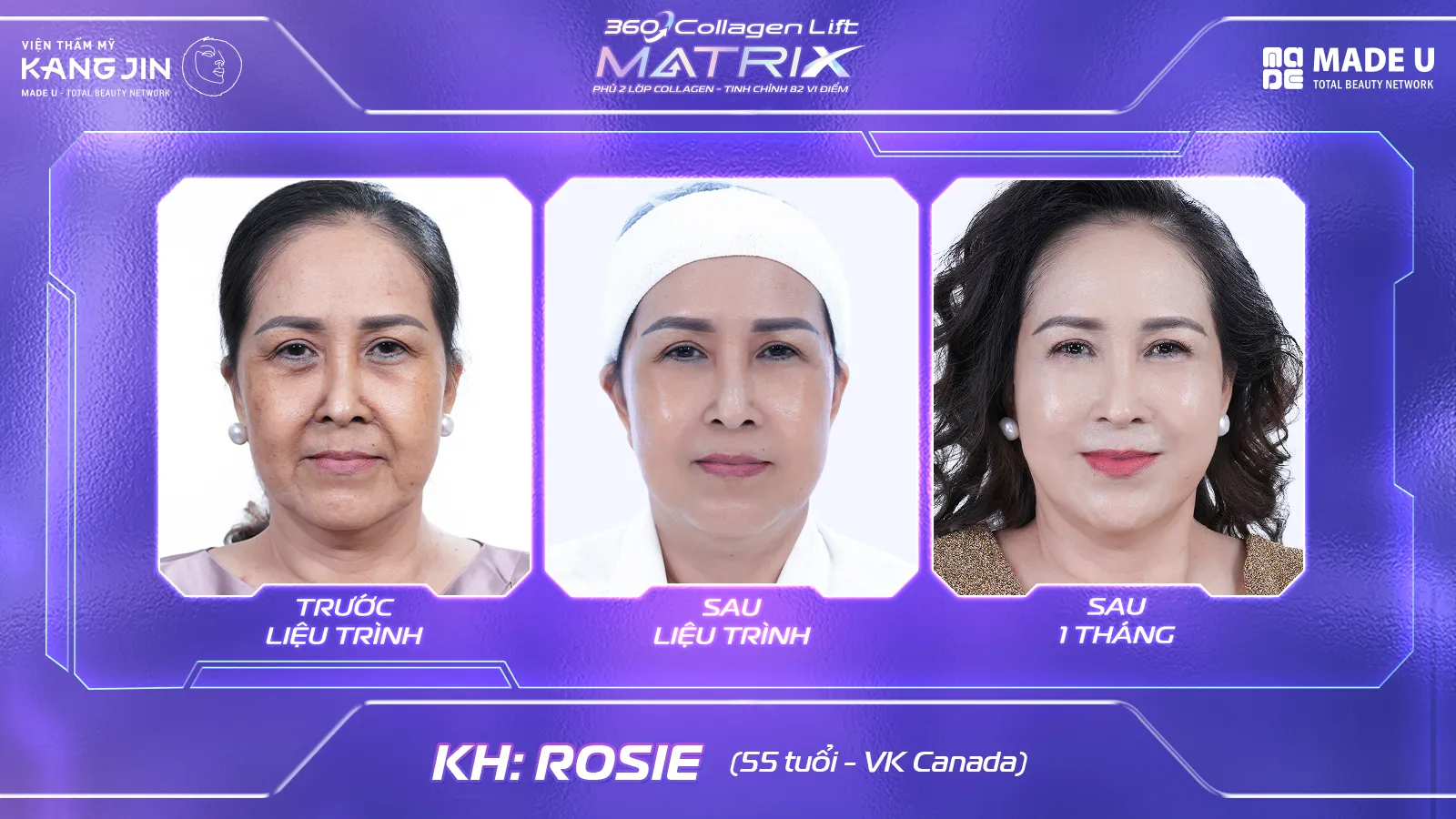Hình ảnh khách hàng thực tế sau liệu trình trẻ hóa 360 Collagen Lift Matrix 