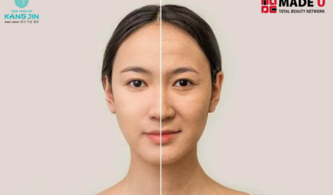 Phương pháp nâng cơ mặt tự nhiên