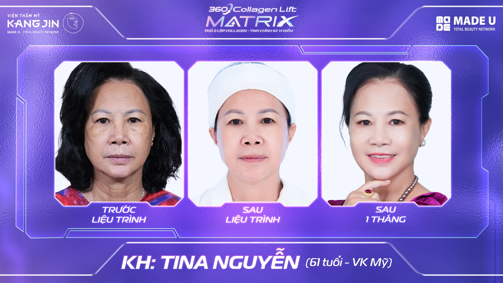 i liệu pháp 360 Collagen Lift Matrix