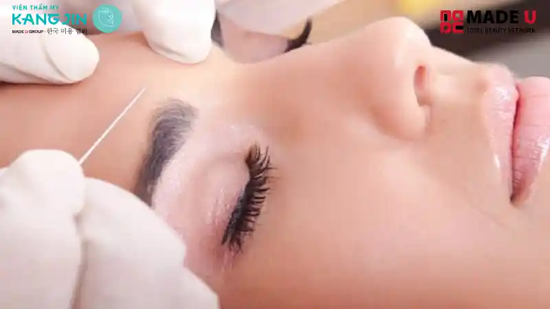 Nâng cung chân mày giúp đưa cung mày lên vị trí cân đối hơn, cải thiện tình trạng da chảy xệ vùng trán – mắt