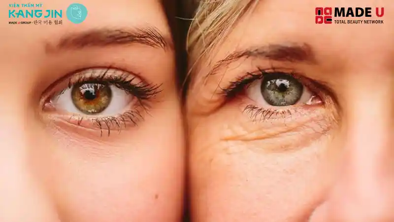 Nâng cung chân mày giúp xóa nếp nhăn trán, vùng quanh mắt..