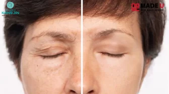 Nâng cung chân mày – Giải pháp trẻ hóa gương mặt được ưa chuộng hiện nay