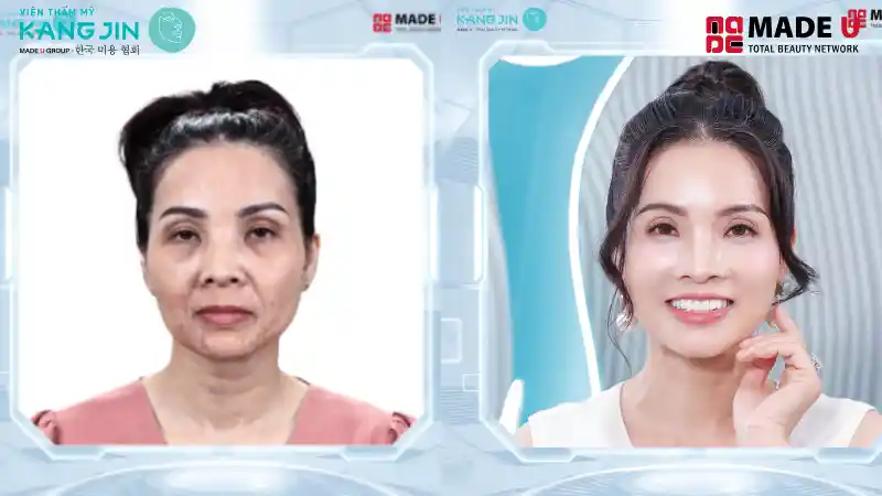 Liệu pháp Matrix 360 Collagen Lift giúp nâng cơ, xóa nhăn, làm đầy vùng trũng hõm