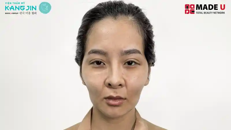 Nguyên nhân gây má hóp có thể do tuổi tác, vấn đề sinh hoạt ăn uống