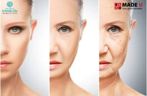 Dấu hiệu chảy xệ cơ mặt biểu hiện rõ mức độ lão hóa trên khuôn mặt