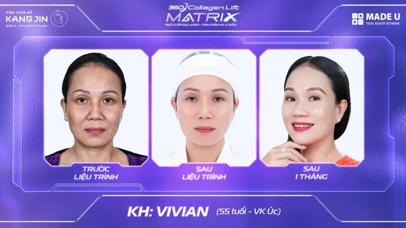 Kết quả thực tế khách hàng sau khi thực hiện 360 Collagen Lift Matrix 