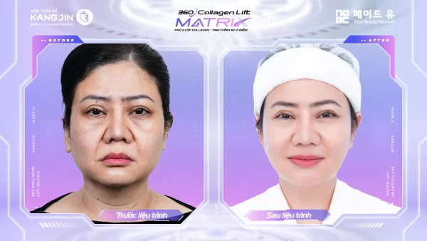 Hiệu quả sử dụng collagen nguyên bài tại VTM Kangjin