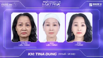 Dịch vụ nâng cơ mặt 360 Collagen Lift Matrix – Viện thẩm mỹ KangJin