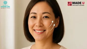 Có nên nâng cơ mặt không? Chuyên gia chia sẻ điều bạn cần biết trước khi làm