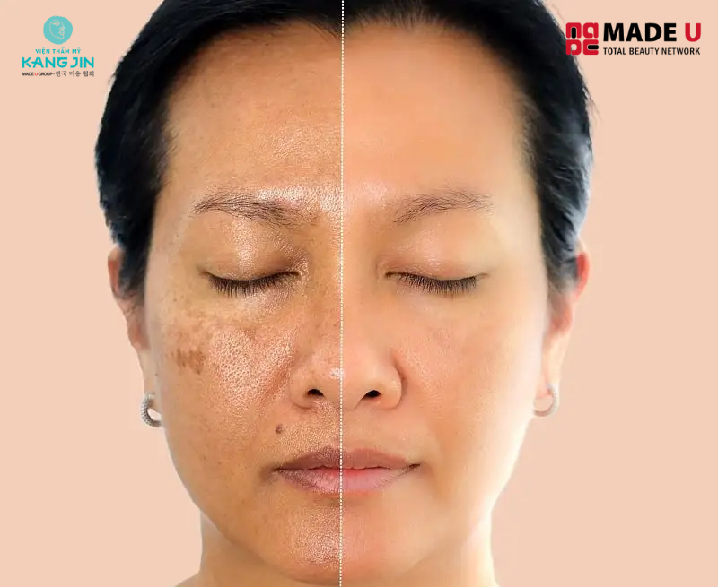 Cấy collagen để cải thiện mức độ lão hóa từ dưới bề mặt da