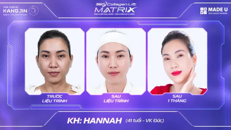Hình ảnh làn da của khách hàng trước và sau khi thực hiện trẻ hóa tại Viện thẩm mỹ KangJin