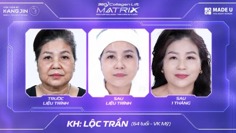 Kết quả thực tế khách hàng sau khi thực hiện trẻ hóa da 360 Collagen Lift Matrix