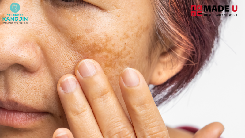 cấy collagen siêu vi điểm có tốt không